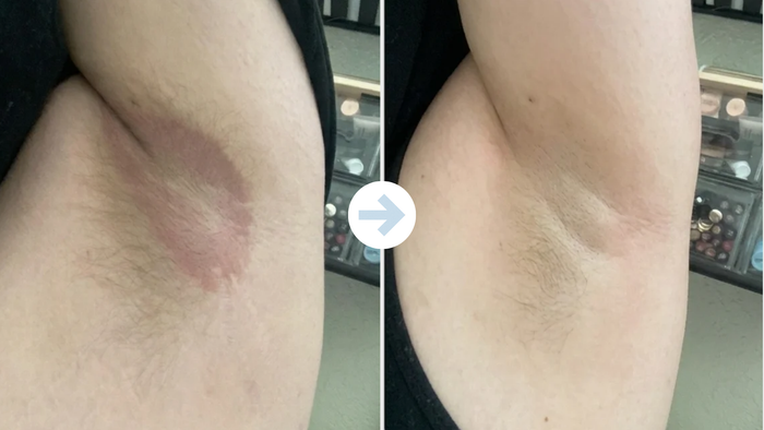 Underarm before and after using the anti-friction stick