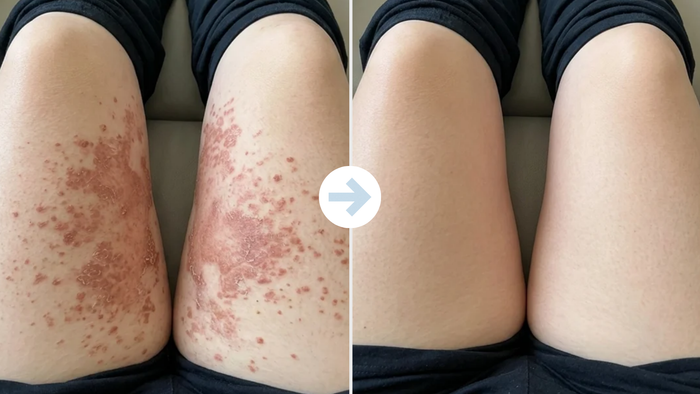 Inner thigh before and after using the anti-friction stick
